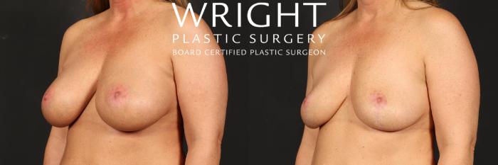 Before & After Breast Implant Removal Case 520 Left Oblique View in Little Rock, Arkansas