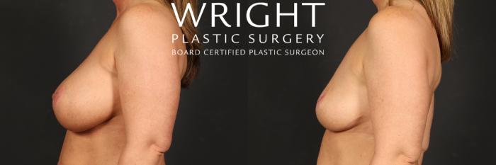 Before & After Breast Implant Removal Case 520 Left Side View in Little Rock, Arkansas