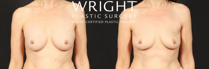 Before & After Breast Implant Removal Case 525 Front View in Little Rock, Arkansas