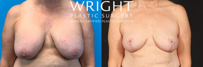 Before & After Breast Lift Case 536 Front View in Little Rock, Arkansas