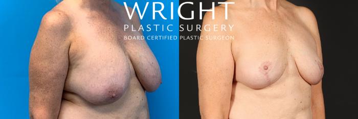 Before & After Breast Implant Removal Case 536 Right Oblique View in Little Rock, Arkansas