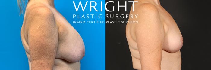 Before & After Breast Lift Case 536 Right Side View in Little Rock, Arkansas