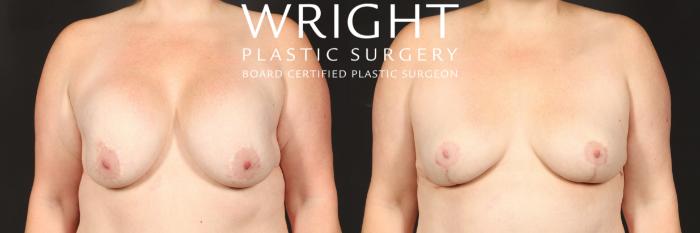 Before & After Breast Implant Removal Case 543 Front View in Little Rock, Arkansas