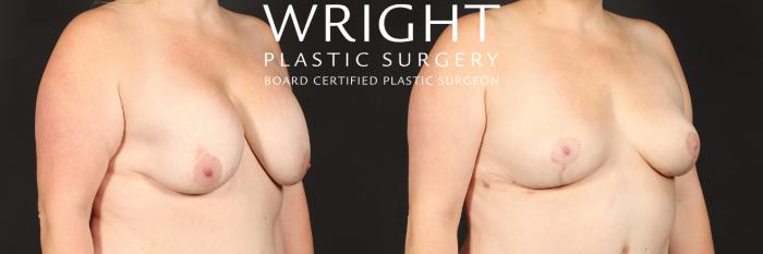 Before & After Breast Implant Removal Case 543 Right Oblique View in Little Rock, Arkansas