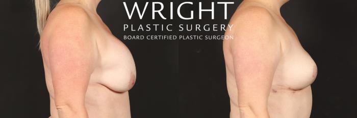 Before & After Breast Implant Removal Case 543 Right Side View in Little Rock, Arkansas