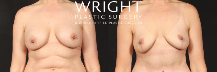 Before & After Breast Lift Case 550 Front View in Little Rock, Arkansas