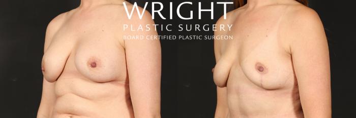 Before & After Breast Implant Removal Case 550 Left Oblique View in Little Rock, Arkansas