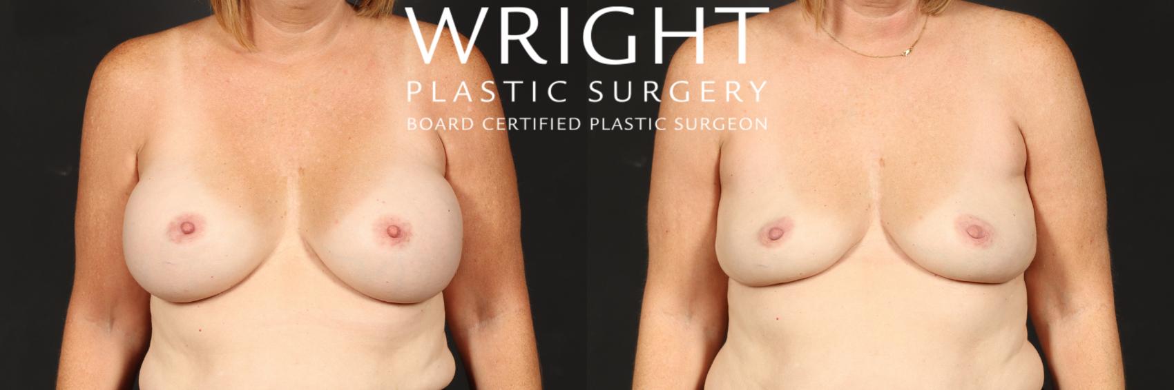 Before & After Breast Implant Removal Case 553 Front View in Little Rock, Arkansas