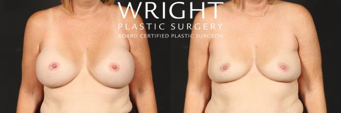 Before & After Breast Implant Removal Case 553 Front View in Little Rock, Arkansas