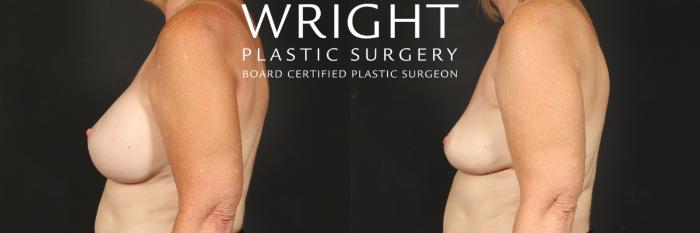 Before & After Breast Implant Removal Case 553 Left Side View in Little Rock, Arkansas