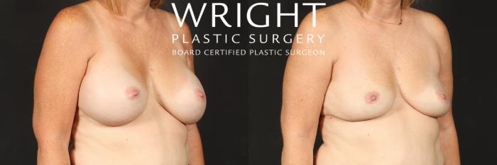 Before & After Breast Implant Removal Case 553 Right Oblique View in Little Rock, Arkansas