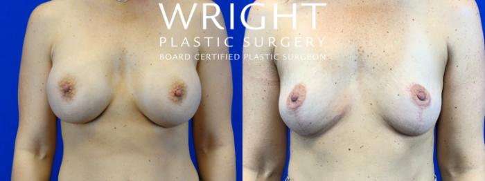 Before & After Breast Implant Removal Case 56 Front View in Little Rock, Arkansas