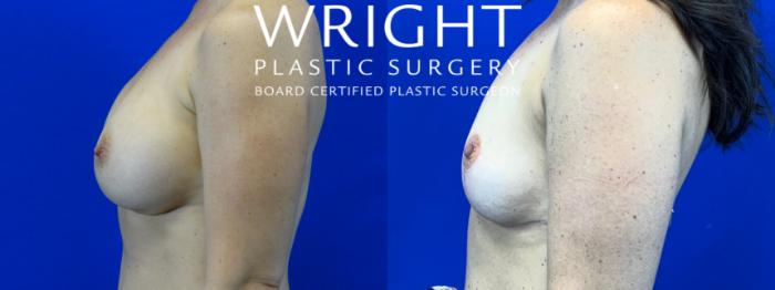 Before & After Breast Implant Removal Case 56 Left Side View in Little Rock, Arkansas