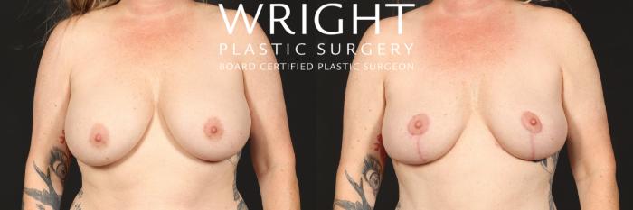 Before & After Breast Implant Removal Case 564 Front View in Little Rock, Arkansas