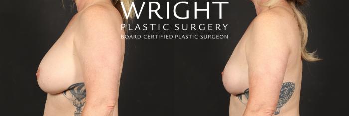 Before & After Breast Implant Removal Case 564 Left Side View in Little Rock, Arkansas