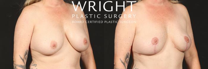 Before & After Breast Implant Removal Case 564 Right Oblique View in Little Rock, Arkansas