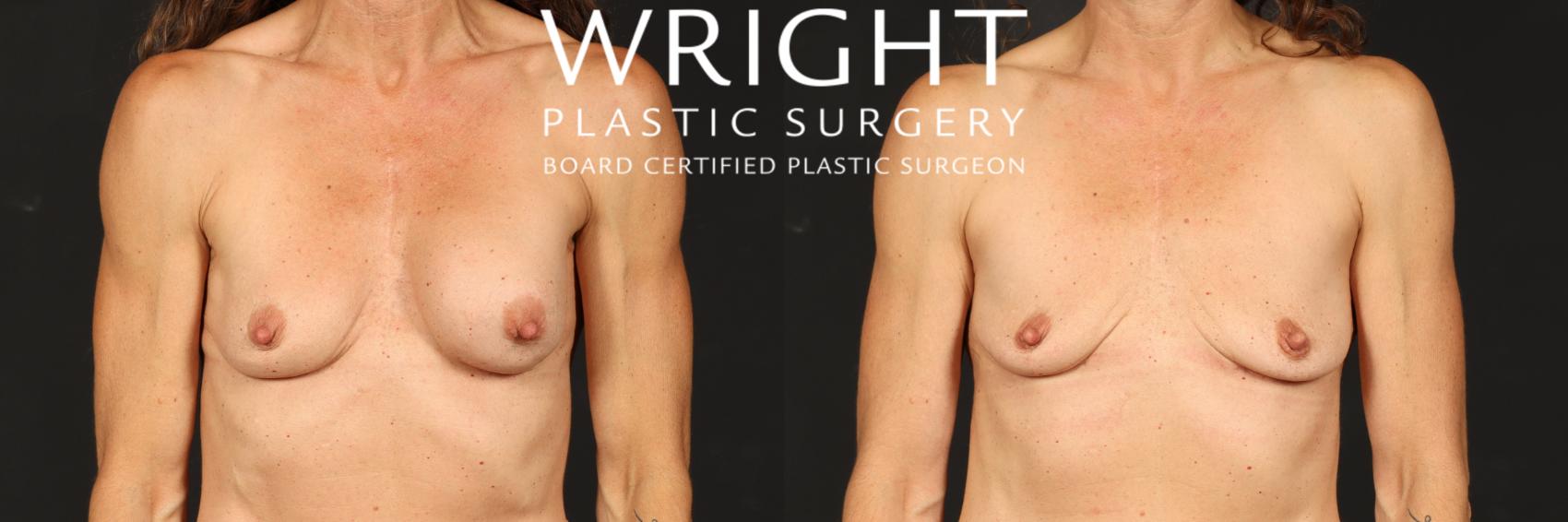 Before & After Breast Implant Removal Case 568 Front View in Little Rock, Arkansas