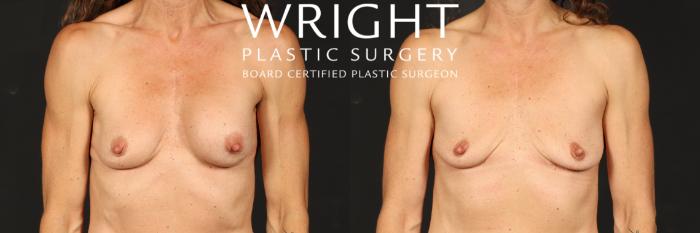 Before & After Breast Implant Removal Case 568 Front View in Little Rock, Arkansas