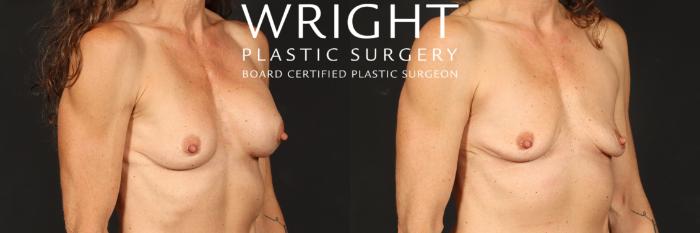 Before & After Breast Implant Removal Case 568 Right Oblique View in Little Rock, Arkansas