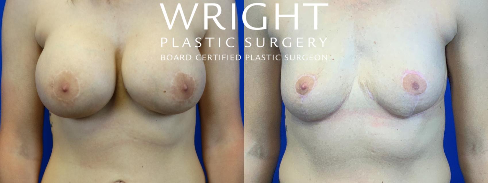 Before & After Breast Lift Case 58 Front View in Little Rock, Arkansas