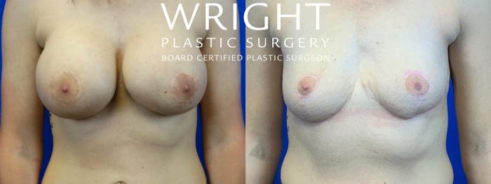 Before & After Breast Implant Removal Case 58 Front View in Little Rock, Arkansas