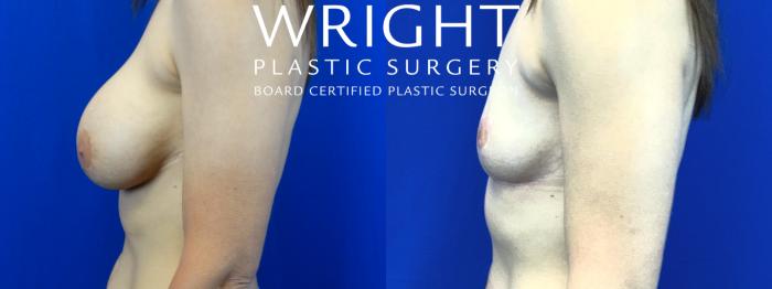 Before & After Breast Lift Case 58 Left Side View in Little Rock, Arkansas