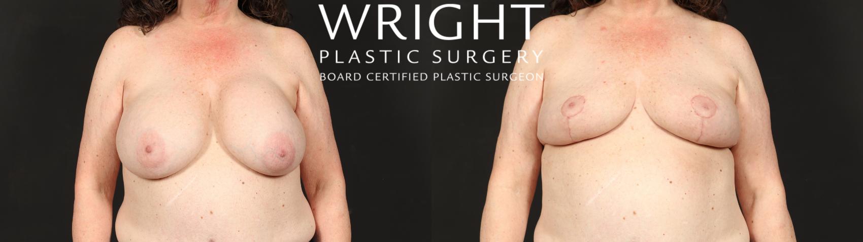 Before & After Breast Implant Removal Case 613 Front View in Little Rock, Arkansas
