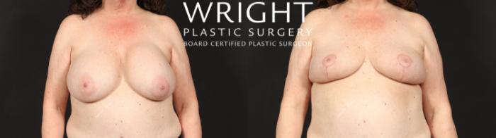 Before & After Breast Implant Removal Case 613 Front View in Little Rock, Arkansas
