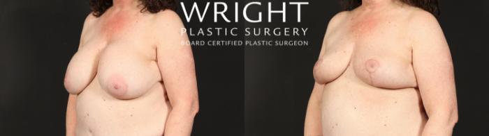 Before & After Breast Implant Removal Case 613 Left Oblique View in Little Rock, Arkansas