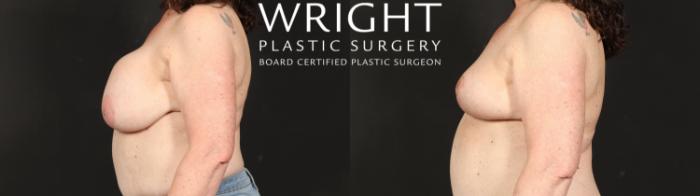 Before & After Breast Implant Removal Case 613 Left Side View in Little Rock, Arkansas