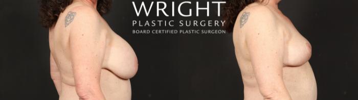 Before & After Breast Implant Removal Case 613 Right Side View in Little Rock, Arkansas