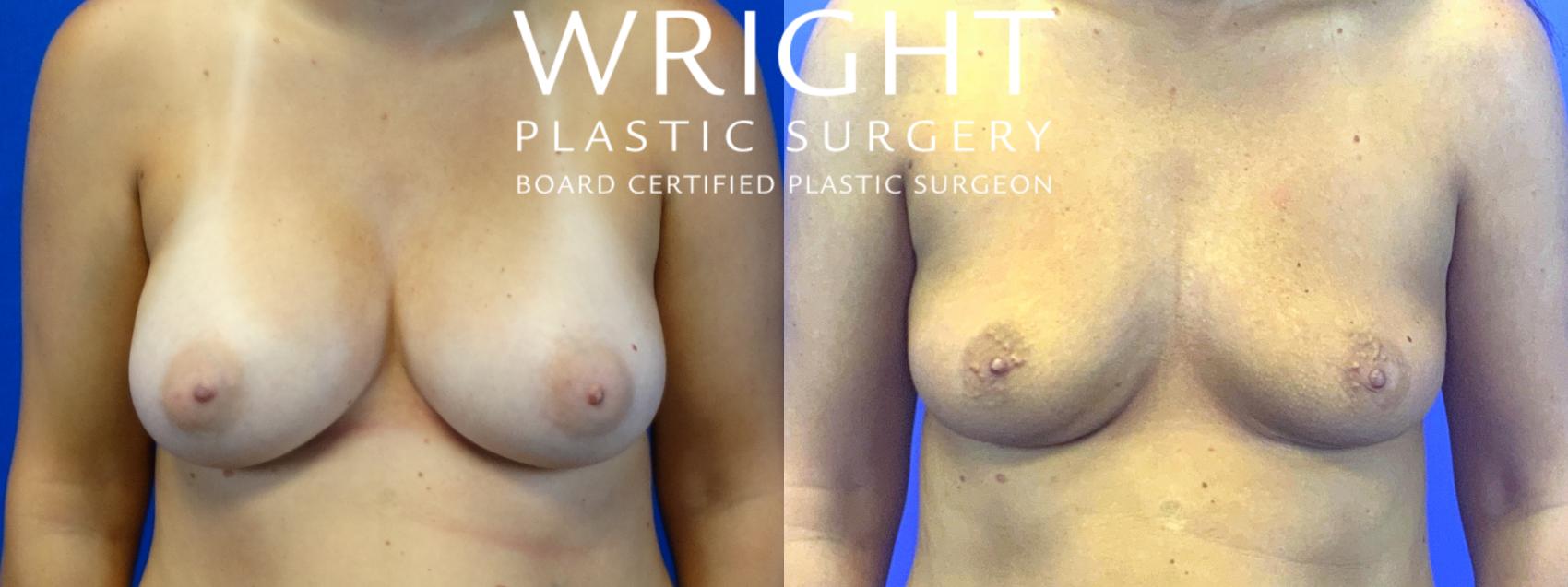 Before & After Breast Implant Removal Case 62 Front View in Little Rock, Arkansas