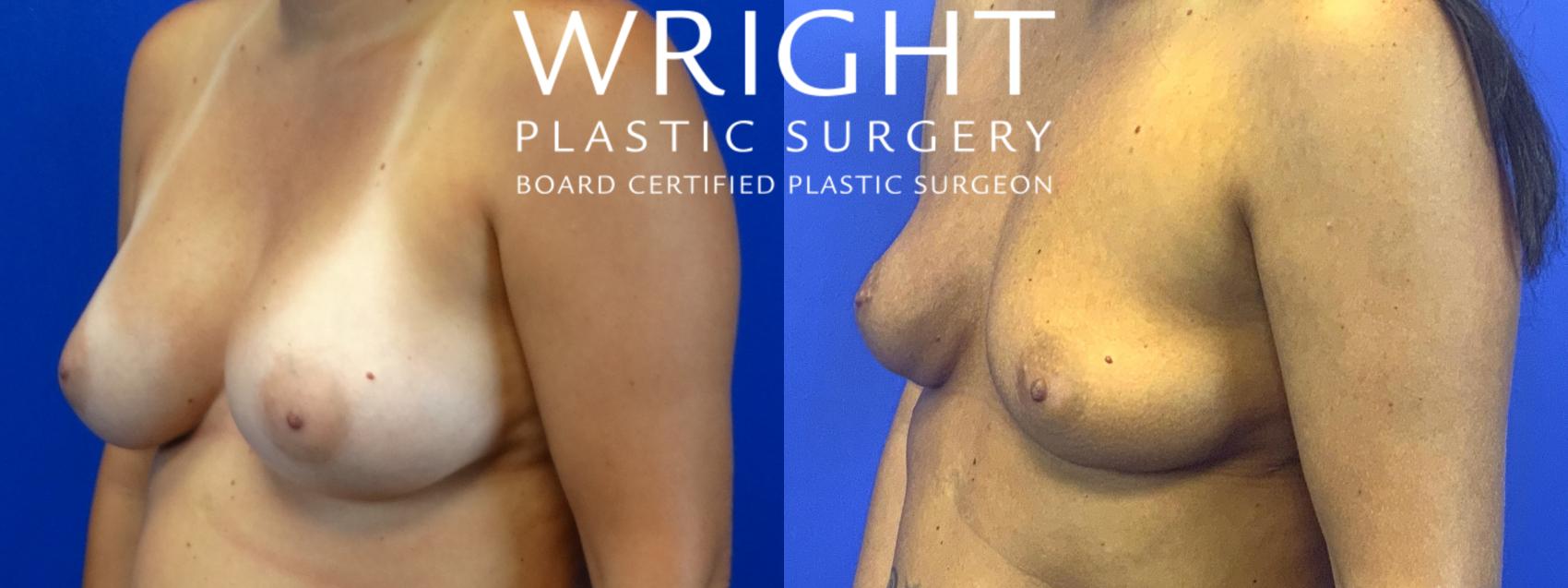 Before & After Breast Implant Removal Case 62 Left Oblique View in Little Rock, Arkansas