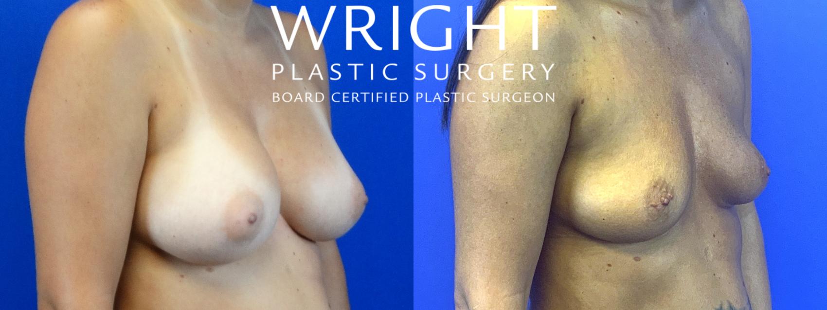 Before & After Breast Implant Removal Case 62 Right Oblique View in Little Rock, Arkansas
