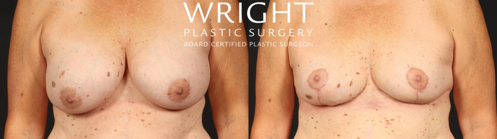 Before & After Breast Implant Removal Case 658 Front View in Little Rock, Arkansas