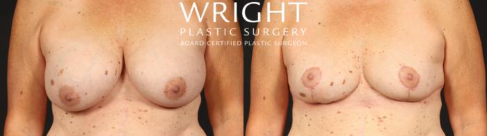 Before & After Breast Implant Removal Case 658 Front View in Little Rock, Arkansas