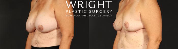 Before & After Breast Implant Removal Case 658 Left Oblique View in Little Rock, Arkansas