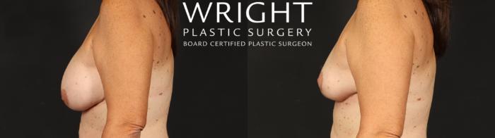 Before & After Breast Implant Removal Case 658 Left Side View in Little Rock, Arkansas