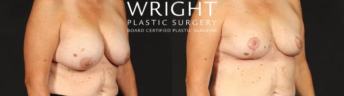 Before & After Breast Implant Removal Case 658 Right Oblique View in Little Rock, Arkansas