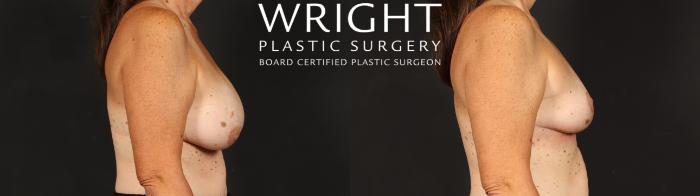 Before & After Breast Implant Removal Case 658 Right Side View in Little Rock, Arkansas