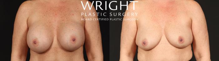 Before & After Breast Implant Removal Case 669 Front View in Little Rock, Arkansas