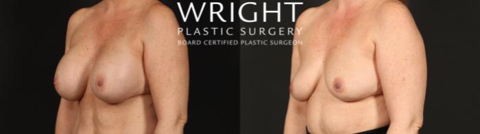 Before & After Breast Implant Removal Case 669 Left Oblique View in Little Rock, Arkansas