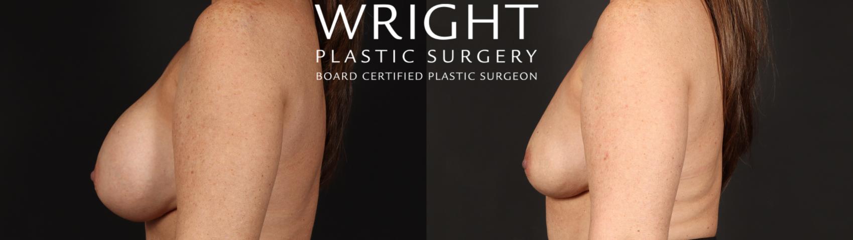 Before & After Breast Implant Removal Case 669 Left Side View in Little Rock, Arkansas