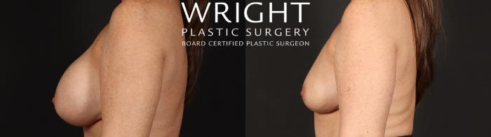 Before & After Breast Implant Removal Case 669 Left Side View in Little Rock, Arkansas