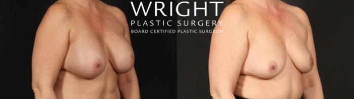 Before & After Breast Implant Removal Case 669 Right Oblique View in Little Rock, Arkansas