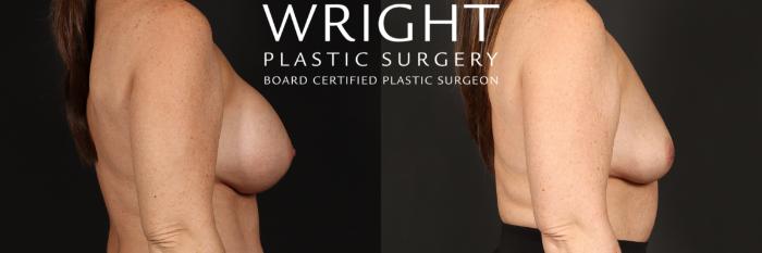 Before & After Breast Implant Removal Case 669 Right Side View in Little Rock, Arkansas