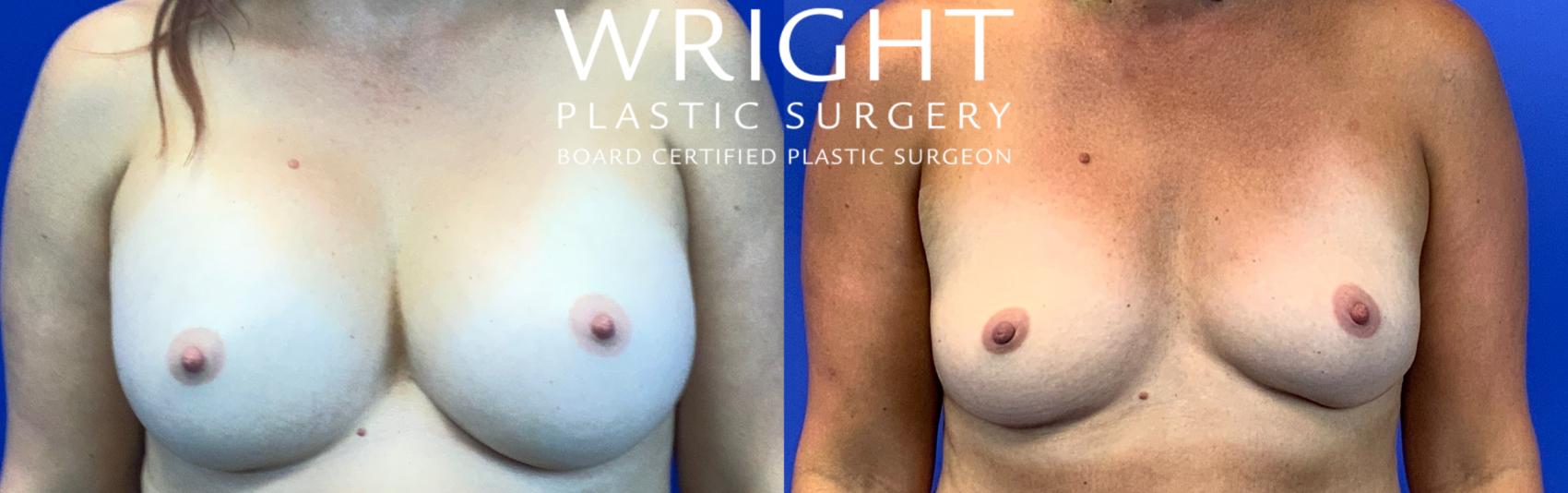 Before & After Breast Implant Removal Case 83 Front View in Little Rock, Arkansas