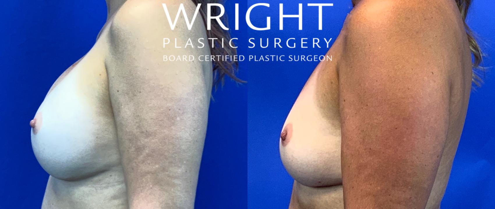 Before & After Breast Implant Removal Case 83 Left Side View in Little Rock, Arkansas