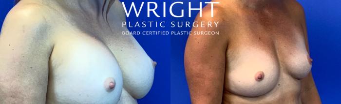 Before & After Breast Implant Removal Case 83 Right Oblique View in Little Rock, Arkansas