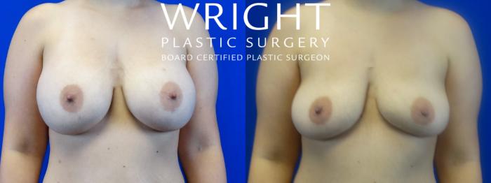 Before & After Breast Implant Removal Case 9 Front View in Little Rock, Arkansas